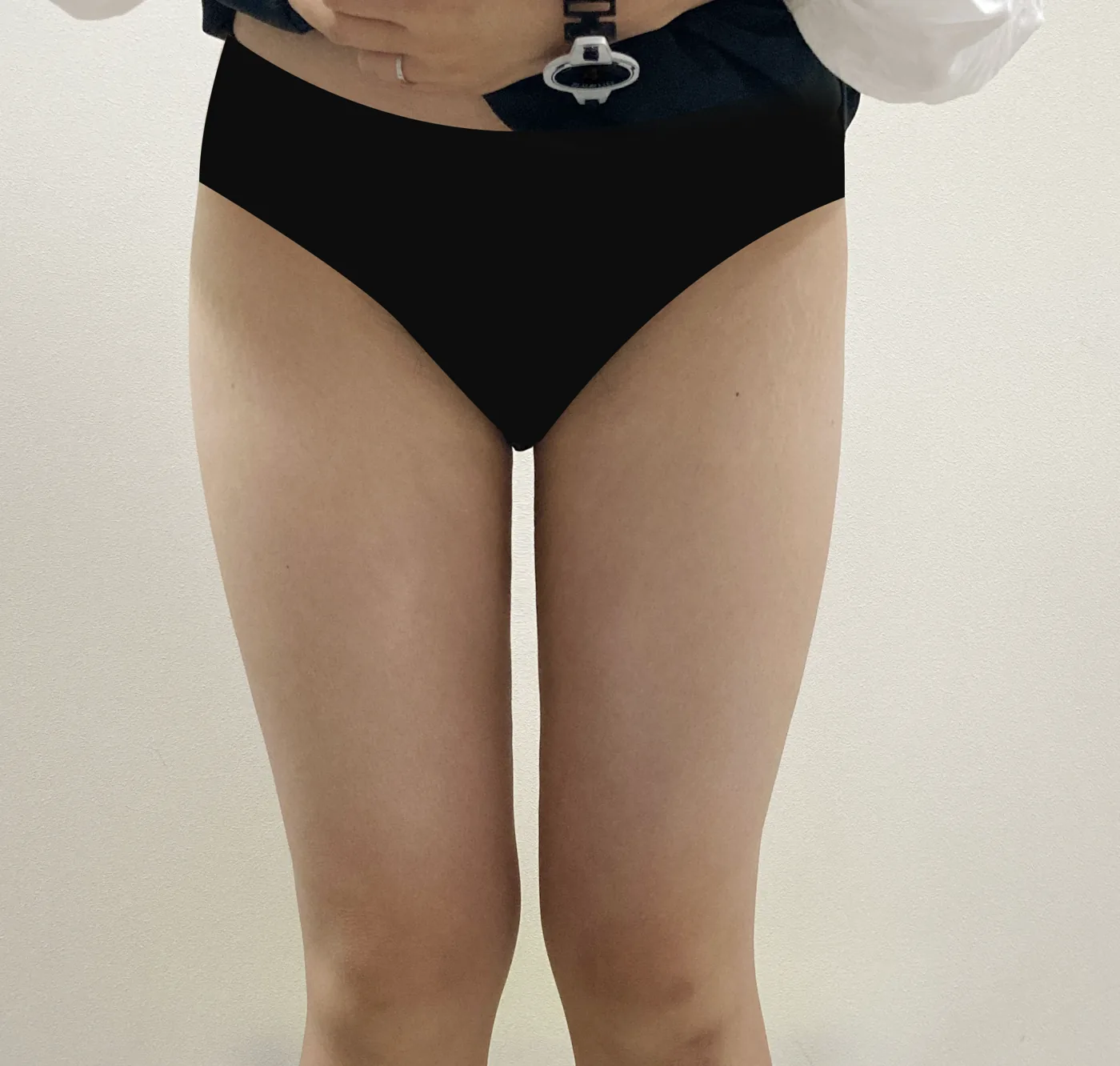 G-fat inner thigh extraction after, G Clinic Gangnam case 31