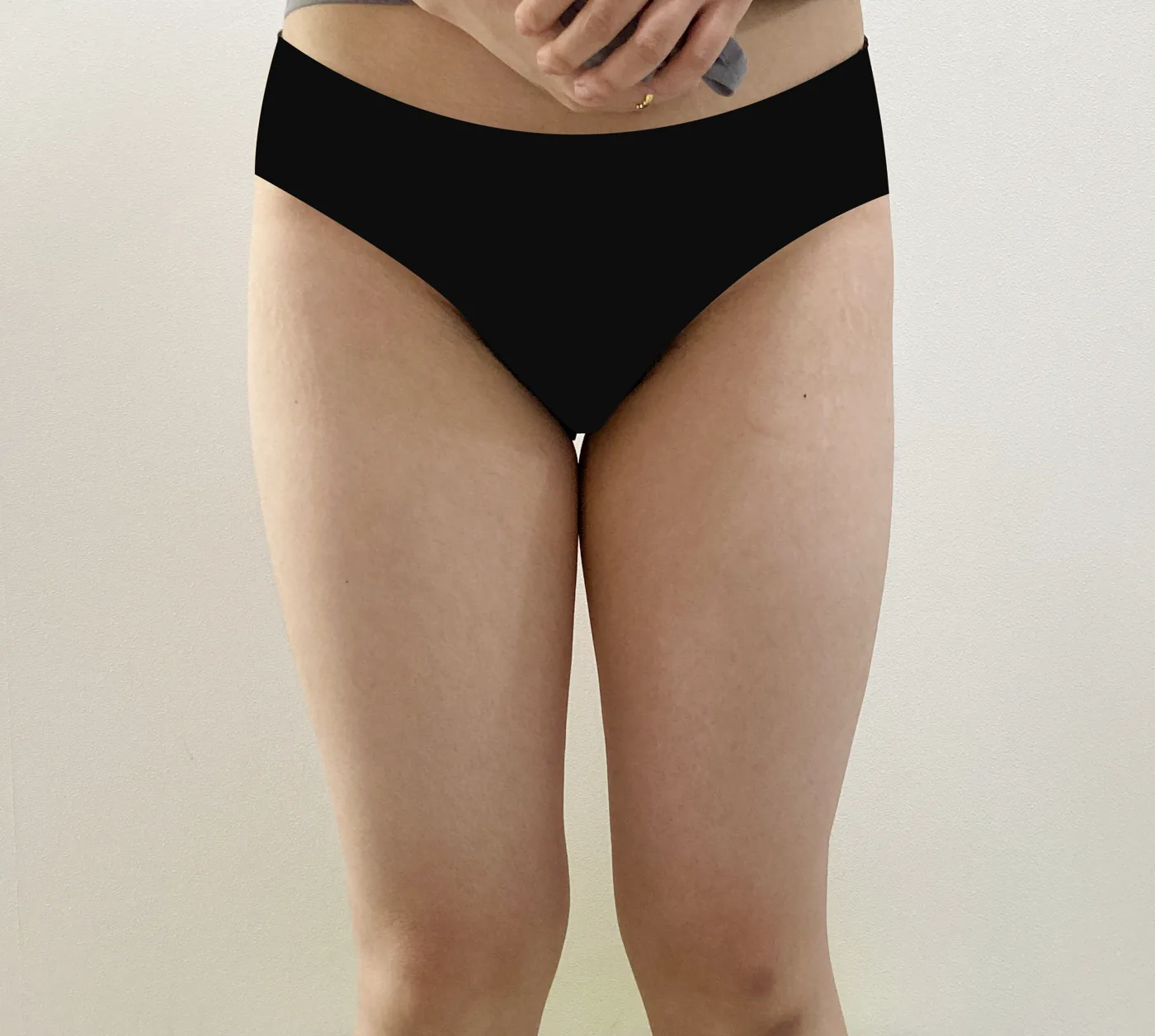 G-fat inner thigh extraction before, G Clinic Gangnam case 31
