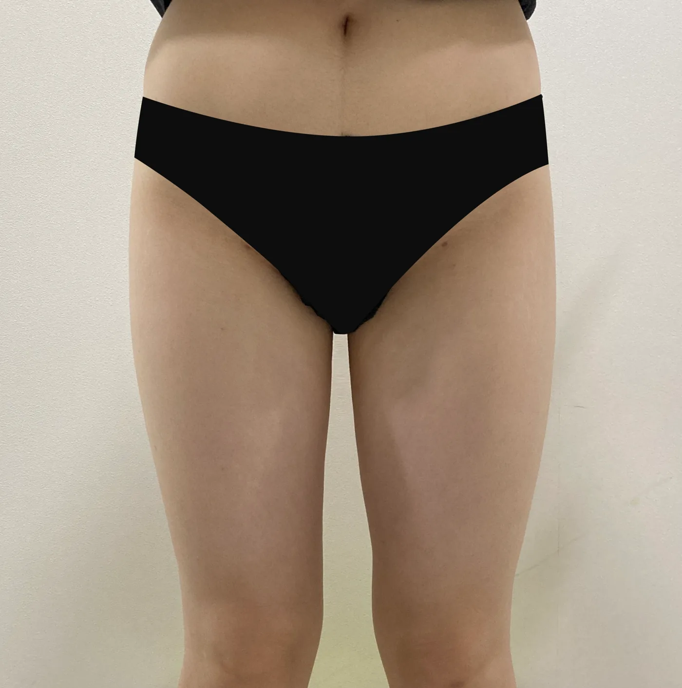 G-fat inner thigh extraction after, G Clinic Gangnam case 32