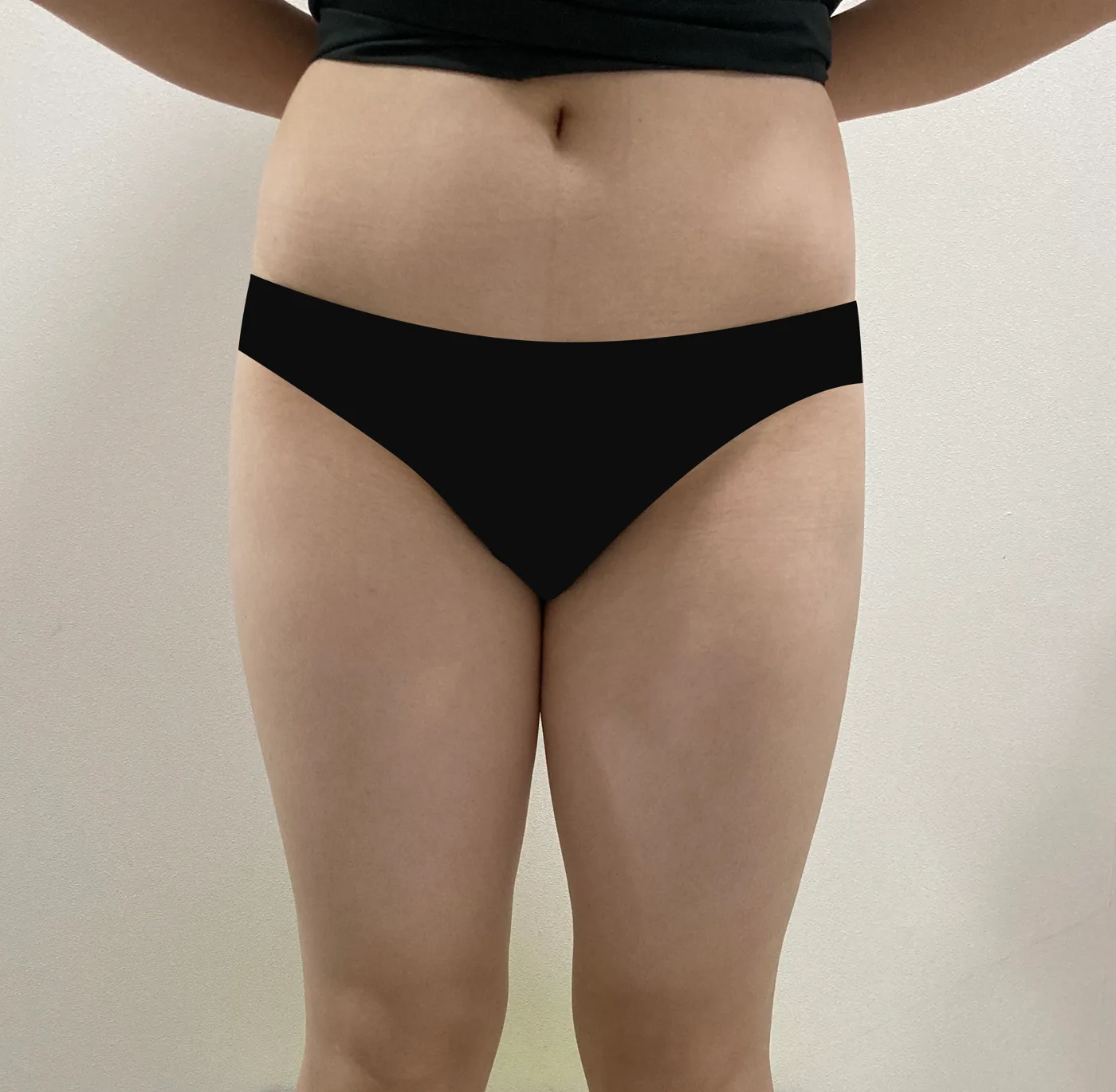 G-fat inner thigh extraction before, G Clinic Gangnam case 32