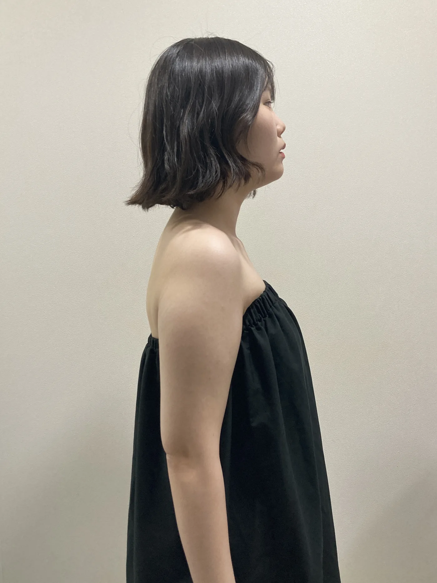 G-fat arm extraction before, G Clinic Gangnam case 33