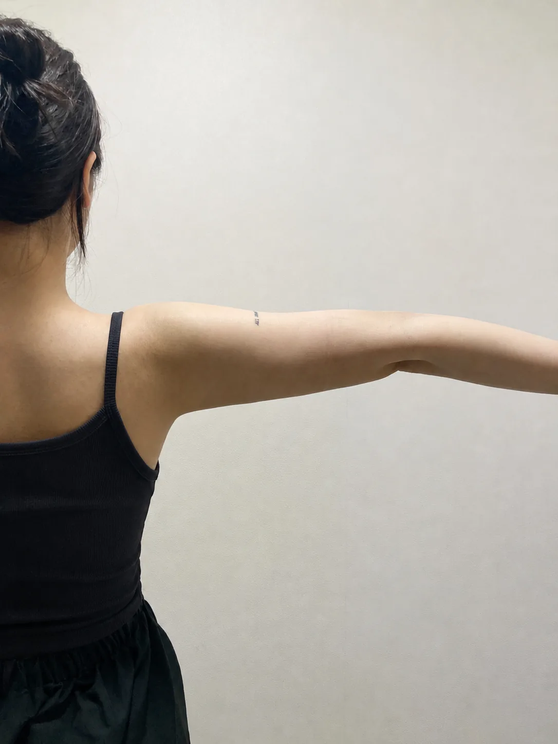 G-fat arm extraction after, G Clinic Gangnam case 34