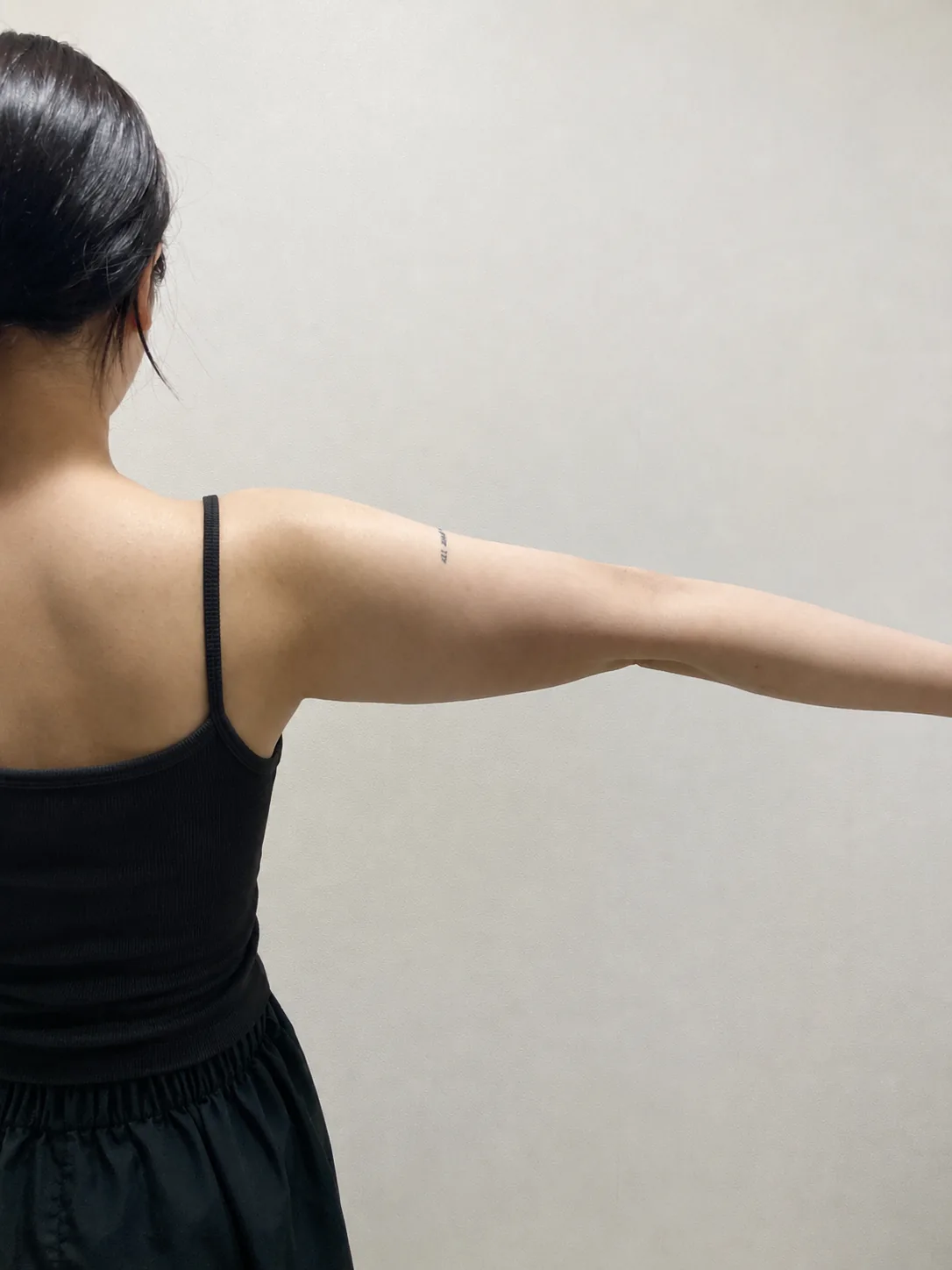 G-fat arm extraction before, G Clinic Gangnam case 34