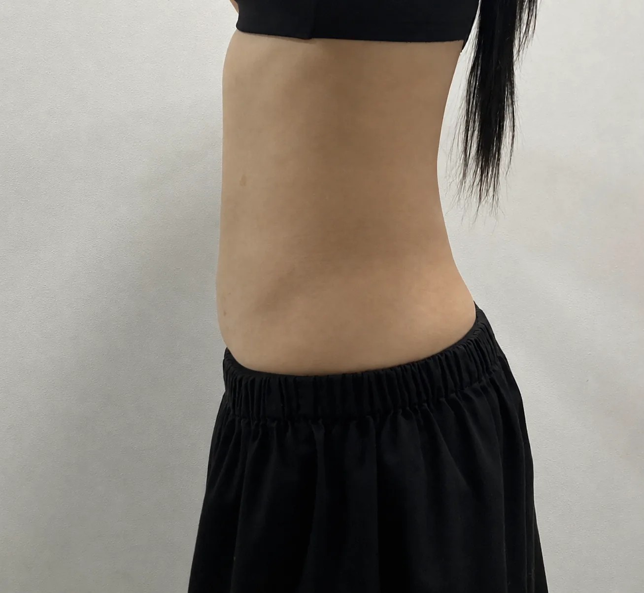 G-fat abdomen extraction after, G Clinic Gangnam case 35