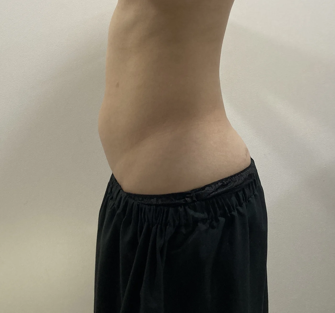 G-fat abdomen extraction before, G Clinic Gangnam case 35