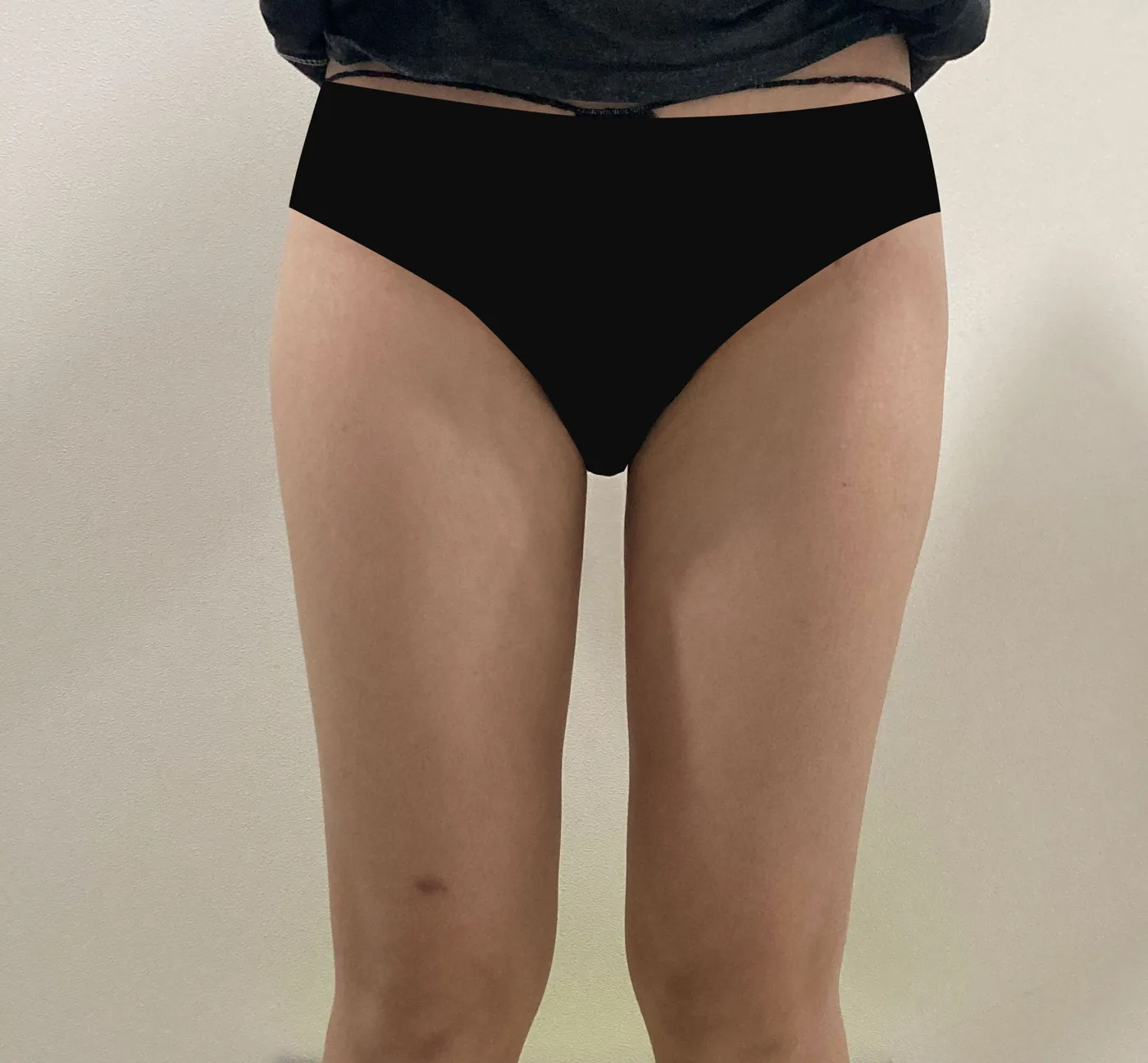 G-fat inner thigh extraction after, G Clinic Gangnam case 38
