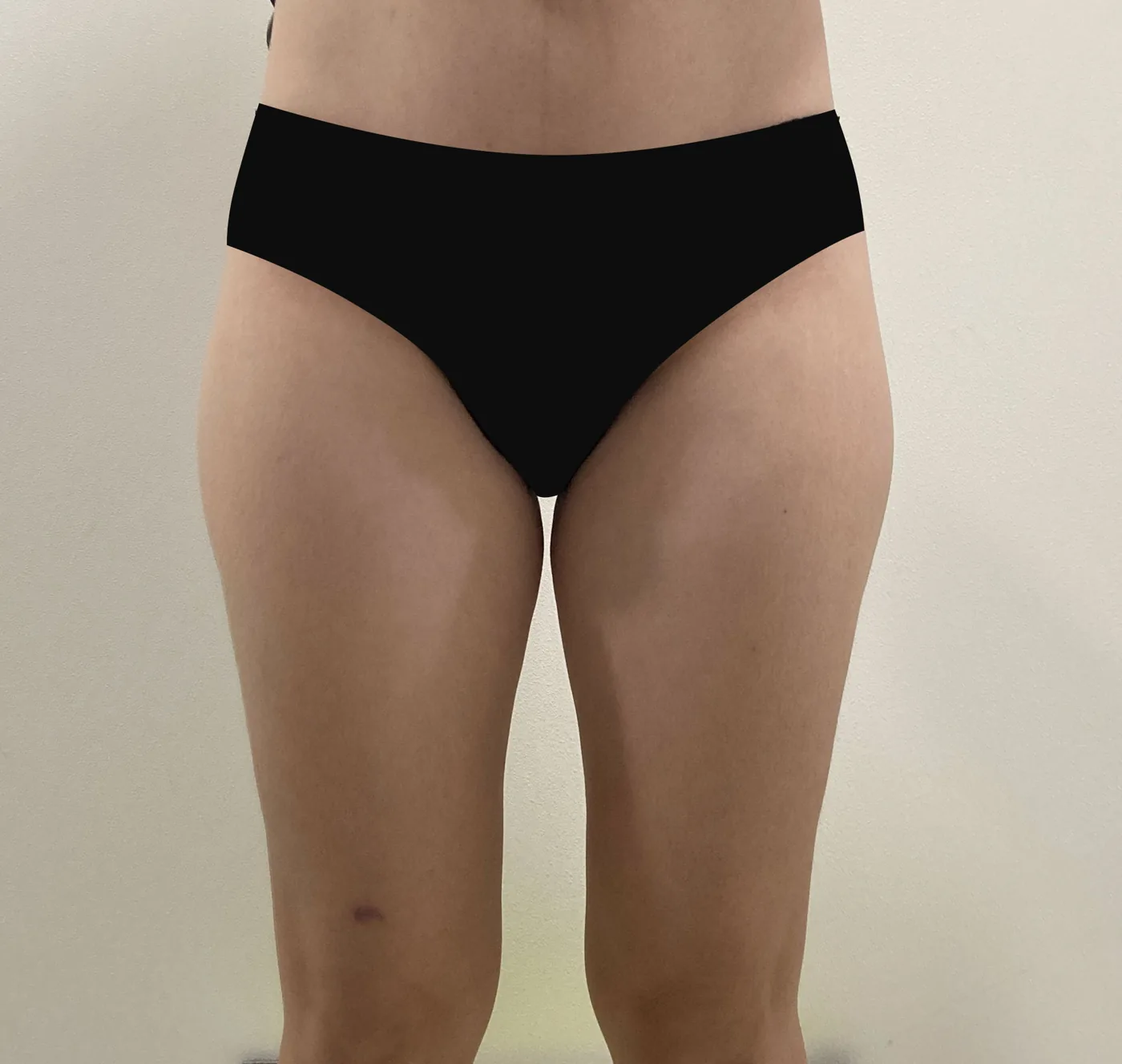 G-fat inner thigh extraction before, G Clinic Gangnam case 38