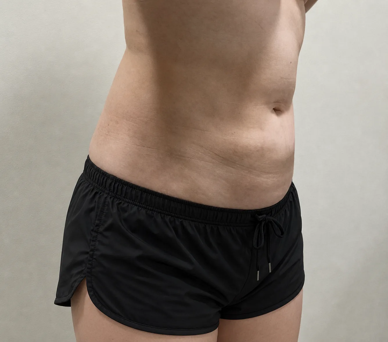 G-fat abdomen extraction after, G Clinic Gangnam case 39