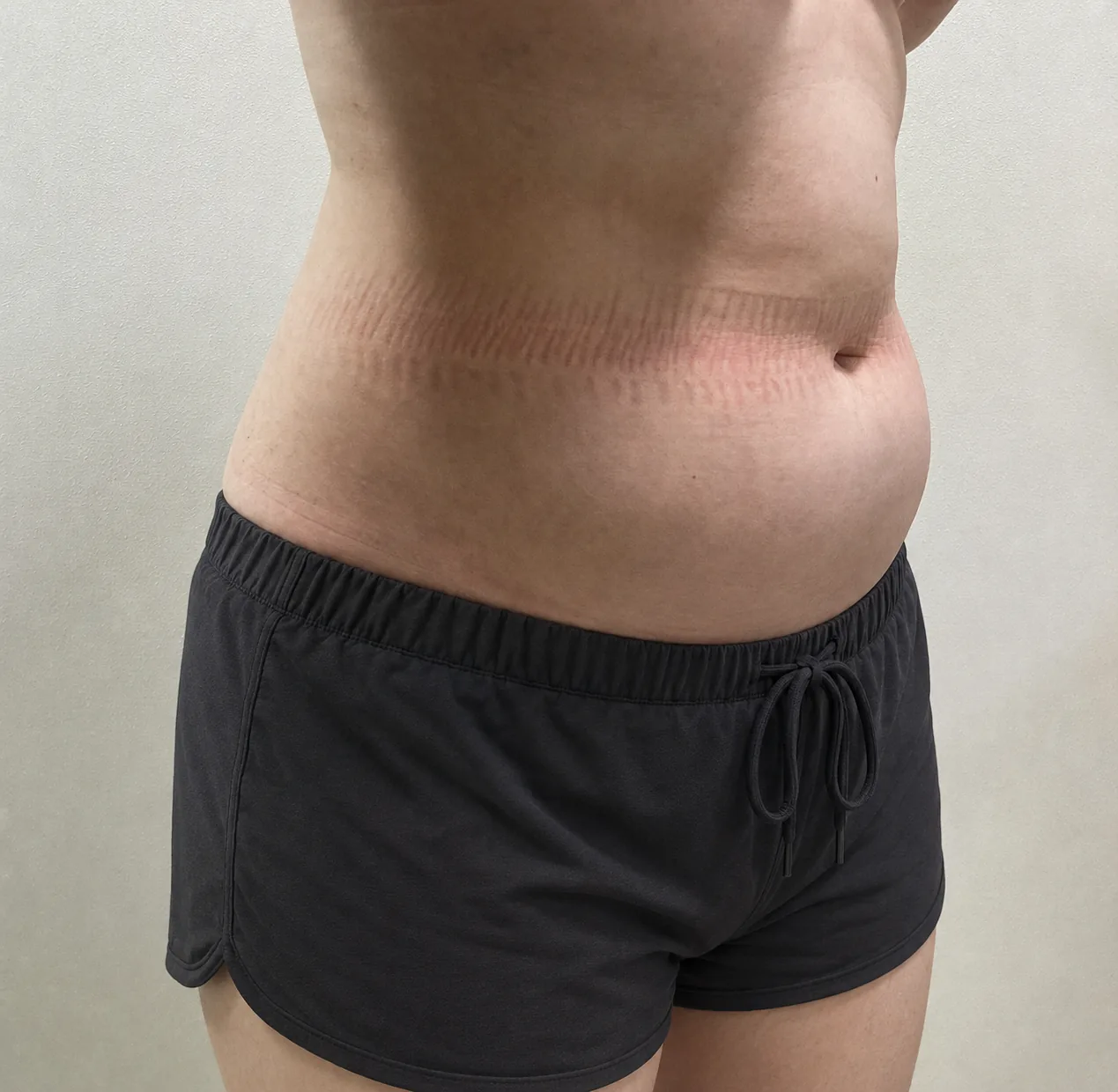 G-fat abdomen extraction before, G Clinic Gangnam case 39
