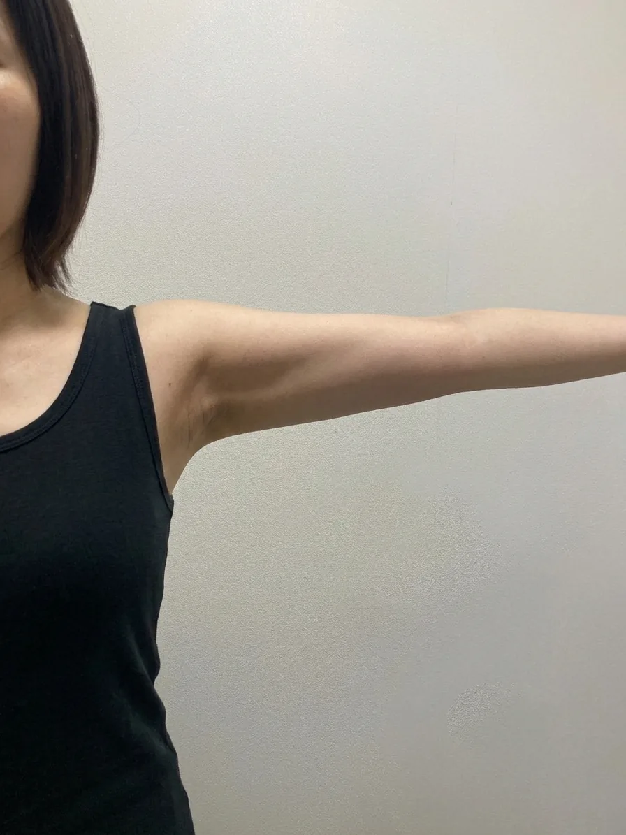 G-fat arm extraction after, G Clinic Gangnam case 40