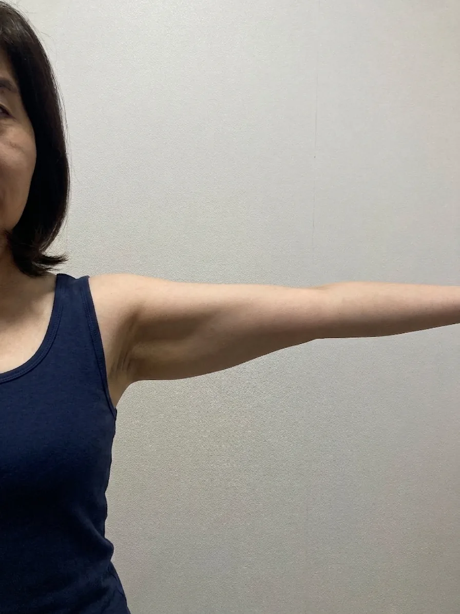 G-fat arm extraction before, G Clinic Gangnam case 40