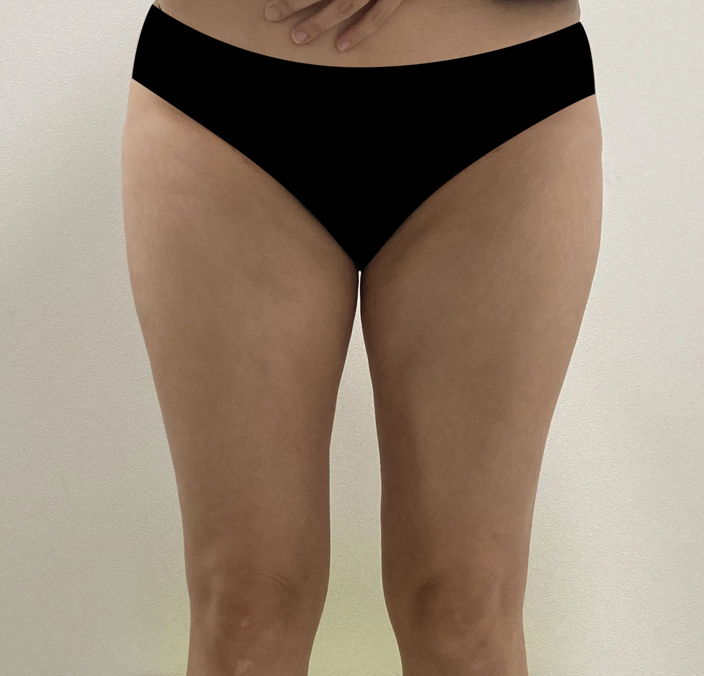 G-fat inner thigh extraction after, G Clinic Gangnam case 41
