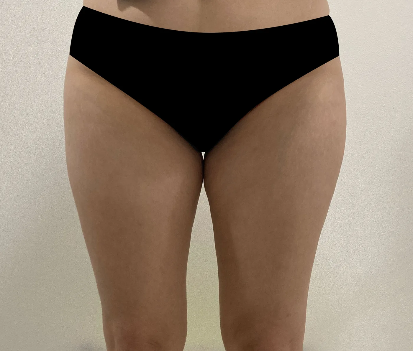 G-fat inner thigh extraction before, G Clinic Gangnam case 41