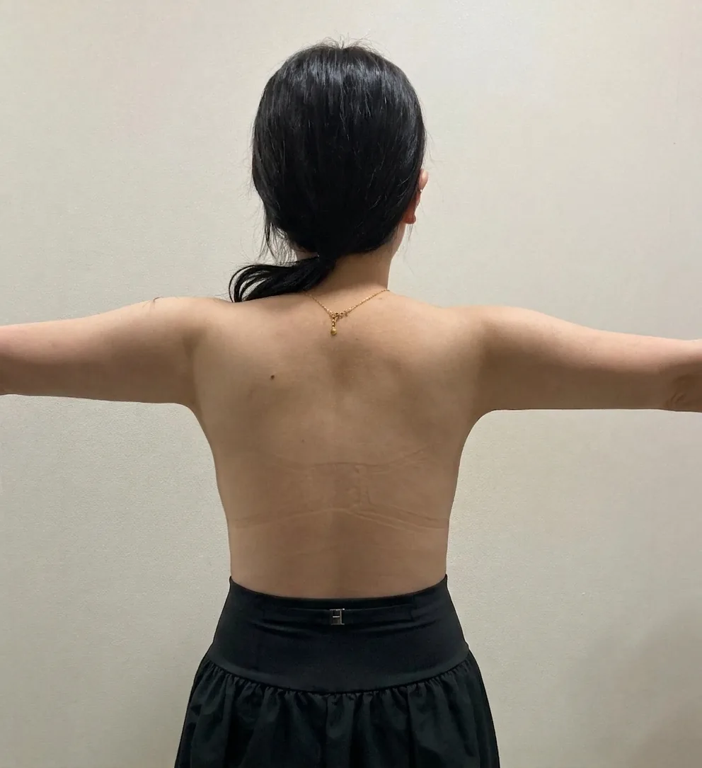G-fat arm extraction after, G Clinic Gangnam case 42