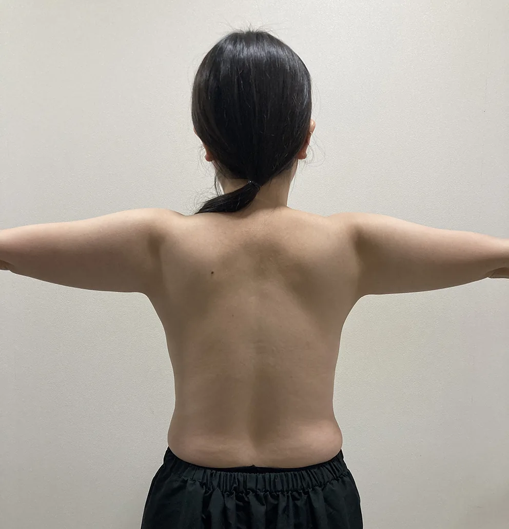 G-fat arm extraction before, G Clinic Gangnam case 42