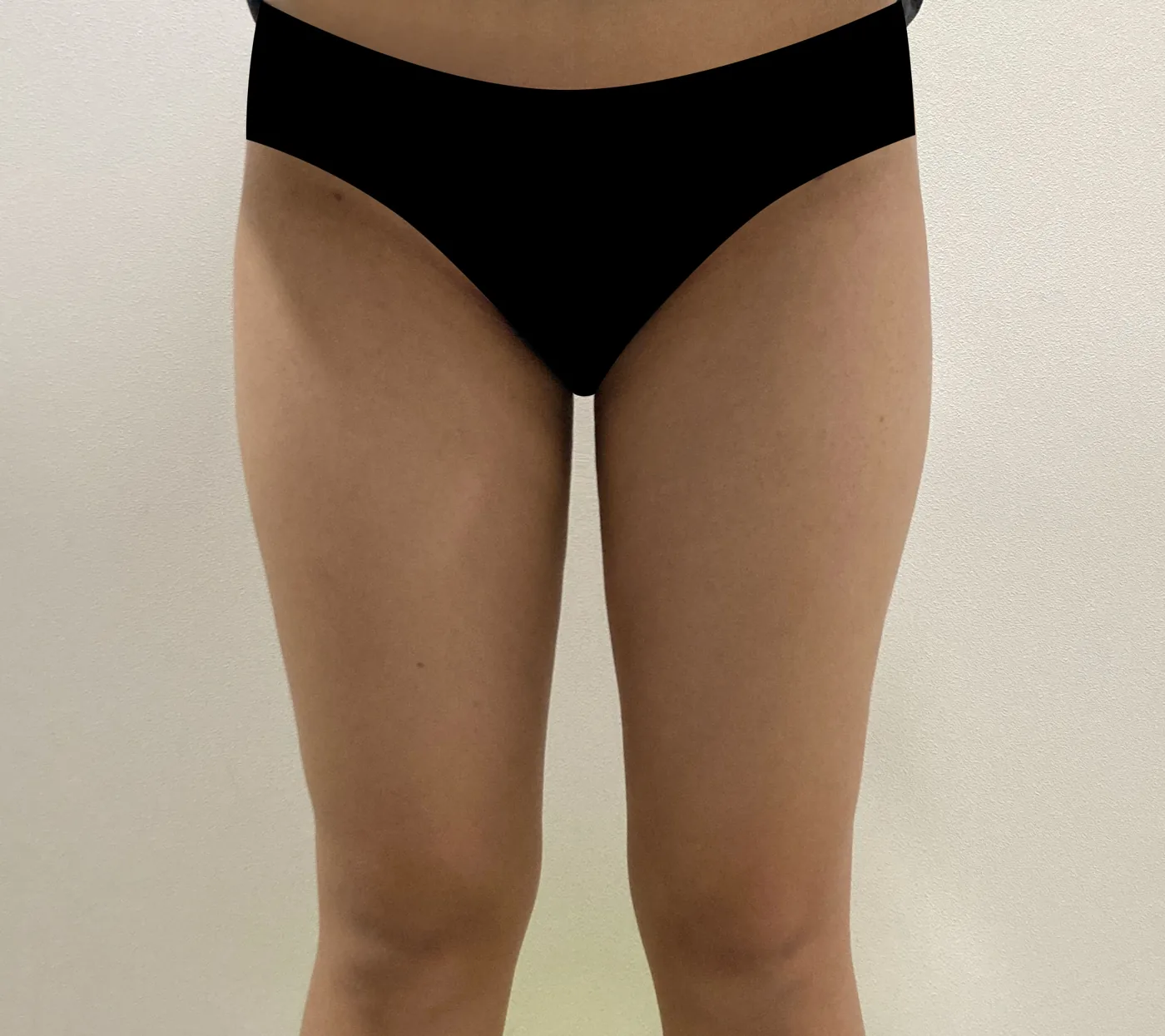 G-fat inner thigh extraction after, G Clinic Gangnam case 45