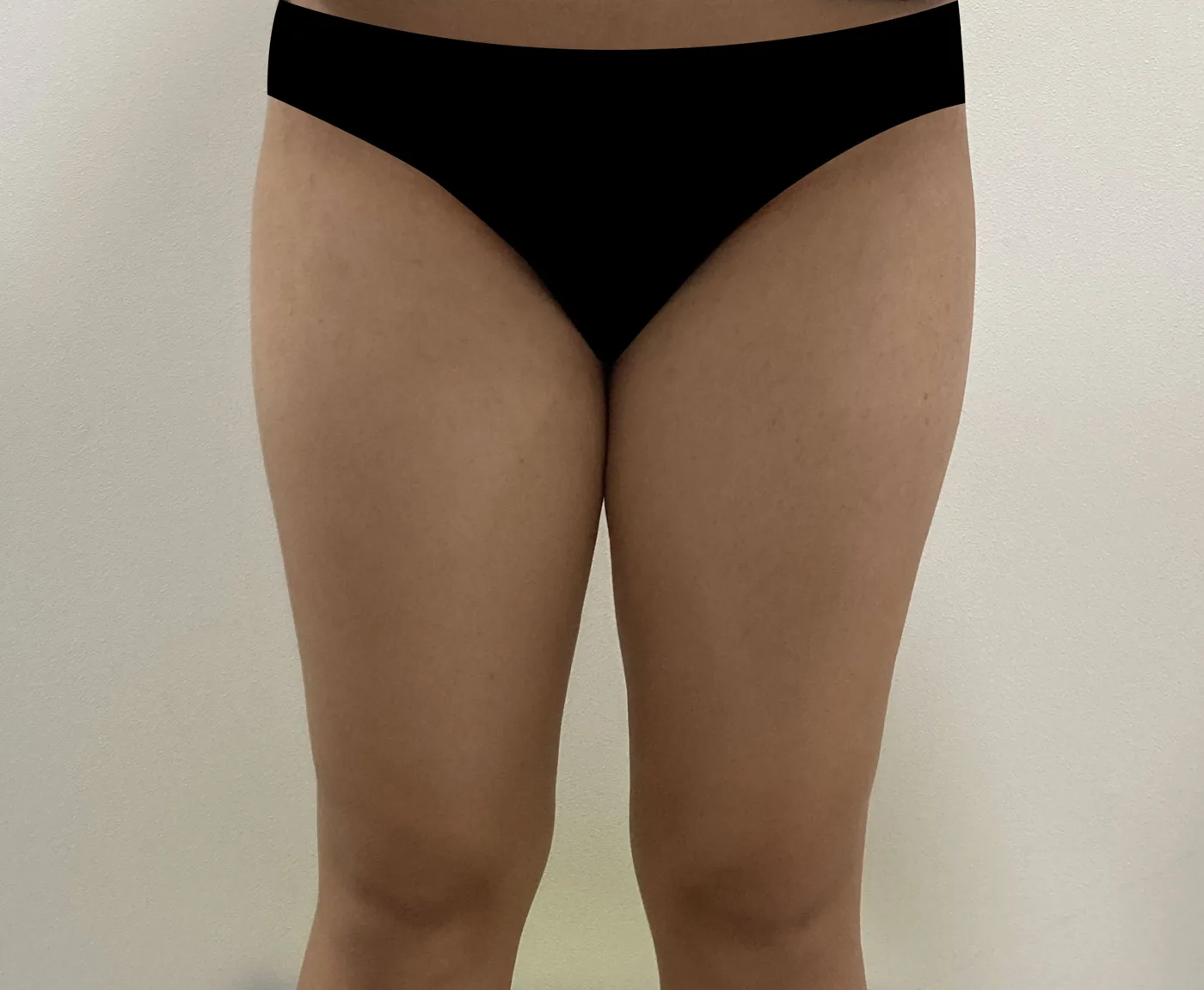 G-fat inner thigh extraction before, G Clinic Gangnam case 45
