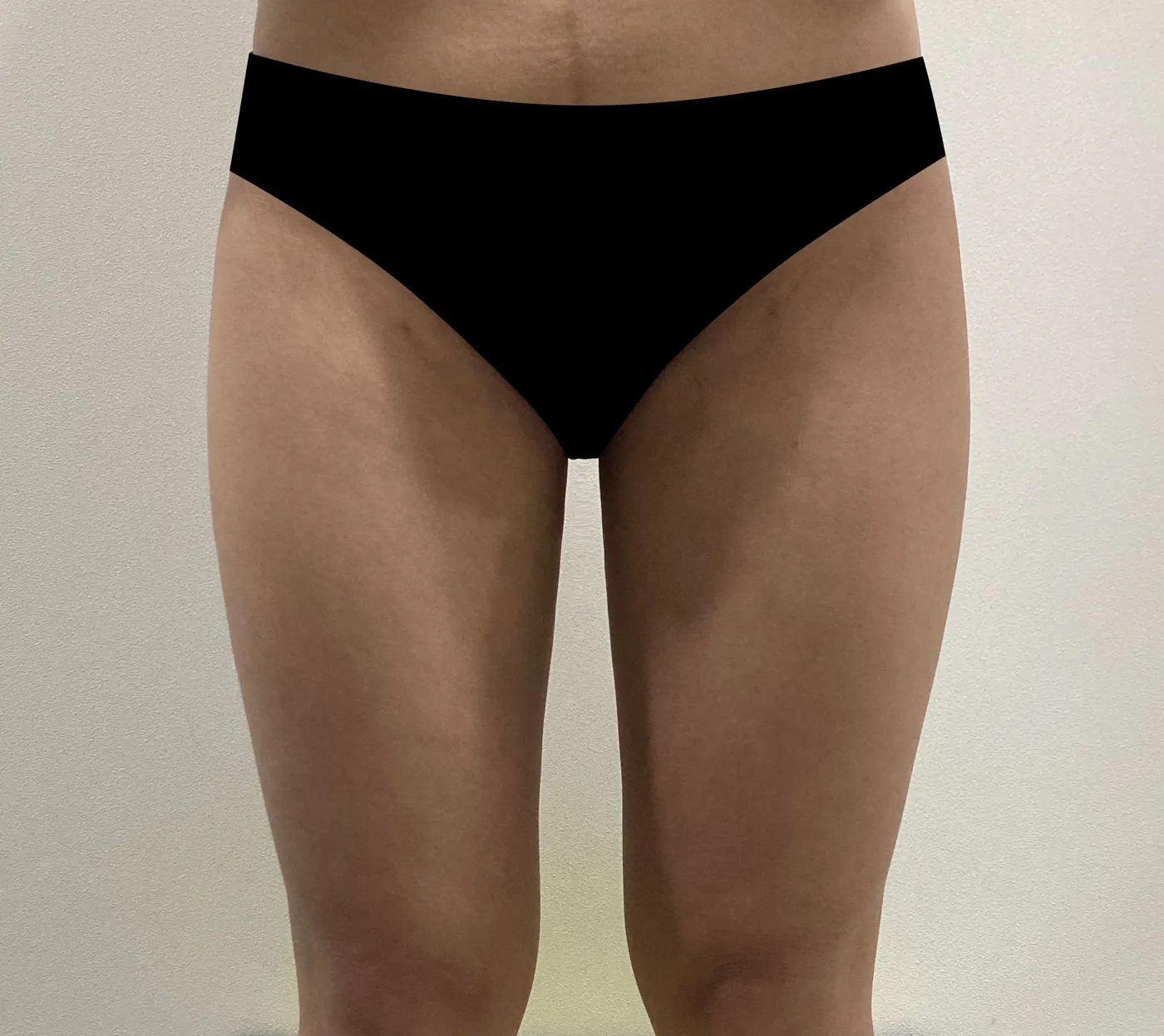 Inner thigh G-fat after, clinic-reported case