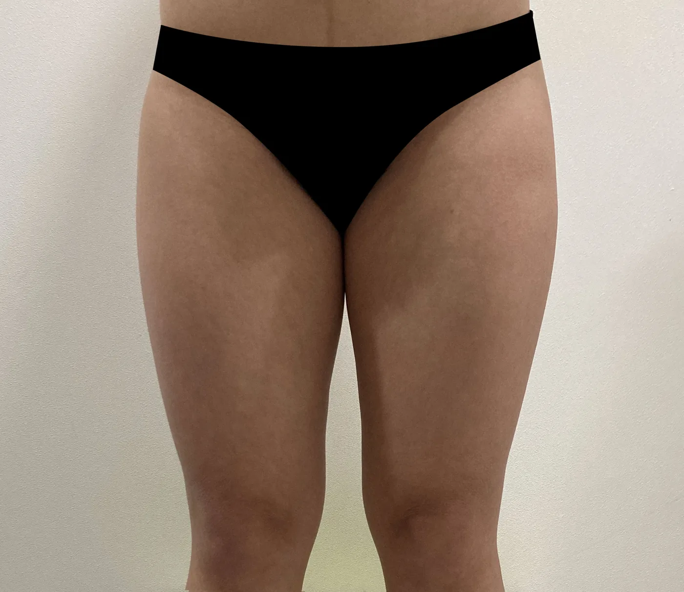 Inner thigh G-fat before, clinic-reported case