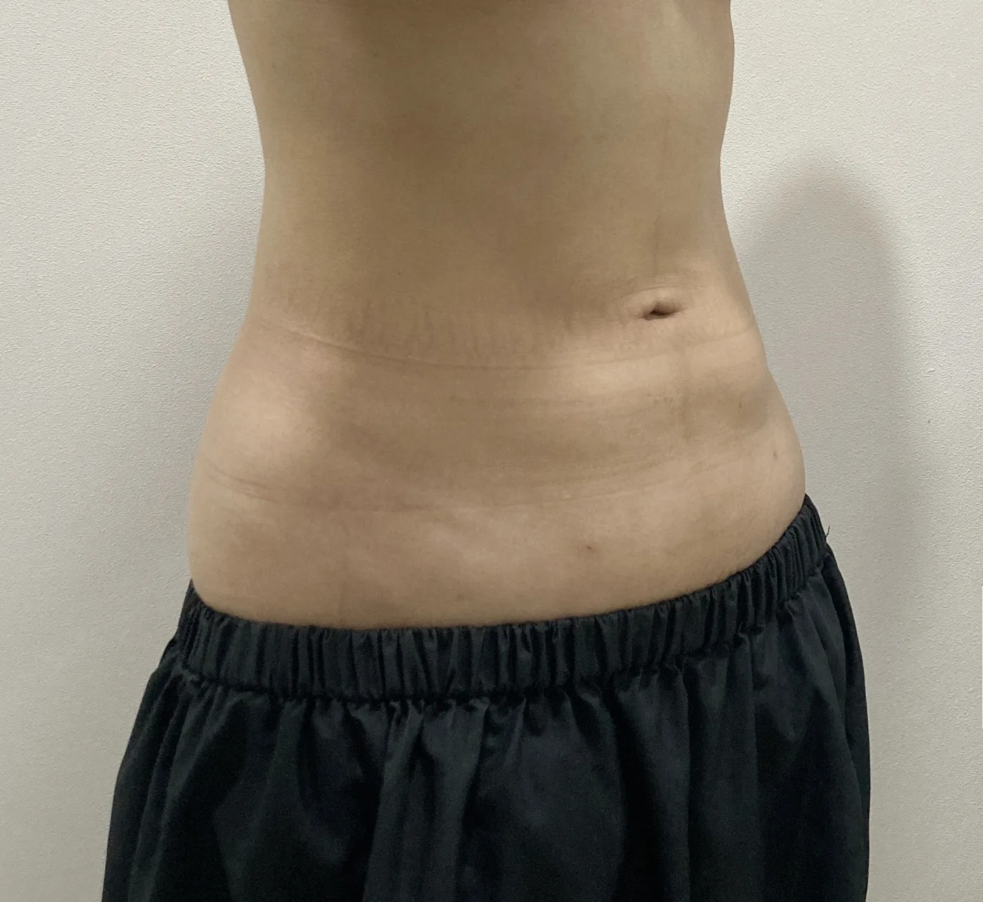 Abdomen G-fat after, clinic-reported case