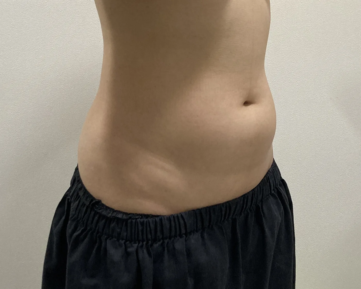 Abdomen G-fat before, clinic-reported case