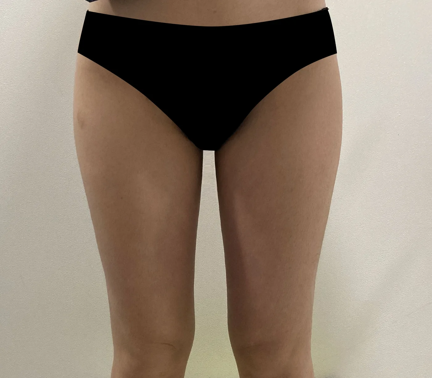 G-fat inner thigh extraction after, G Clinic Gangnam case 49
