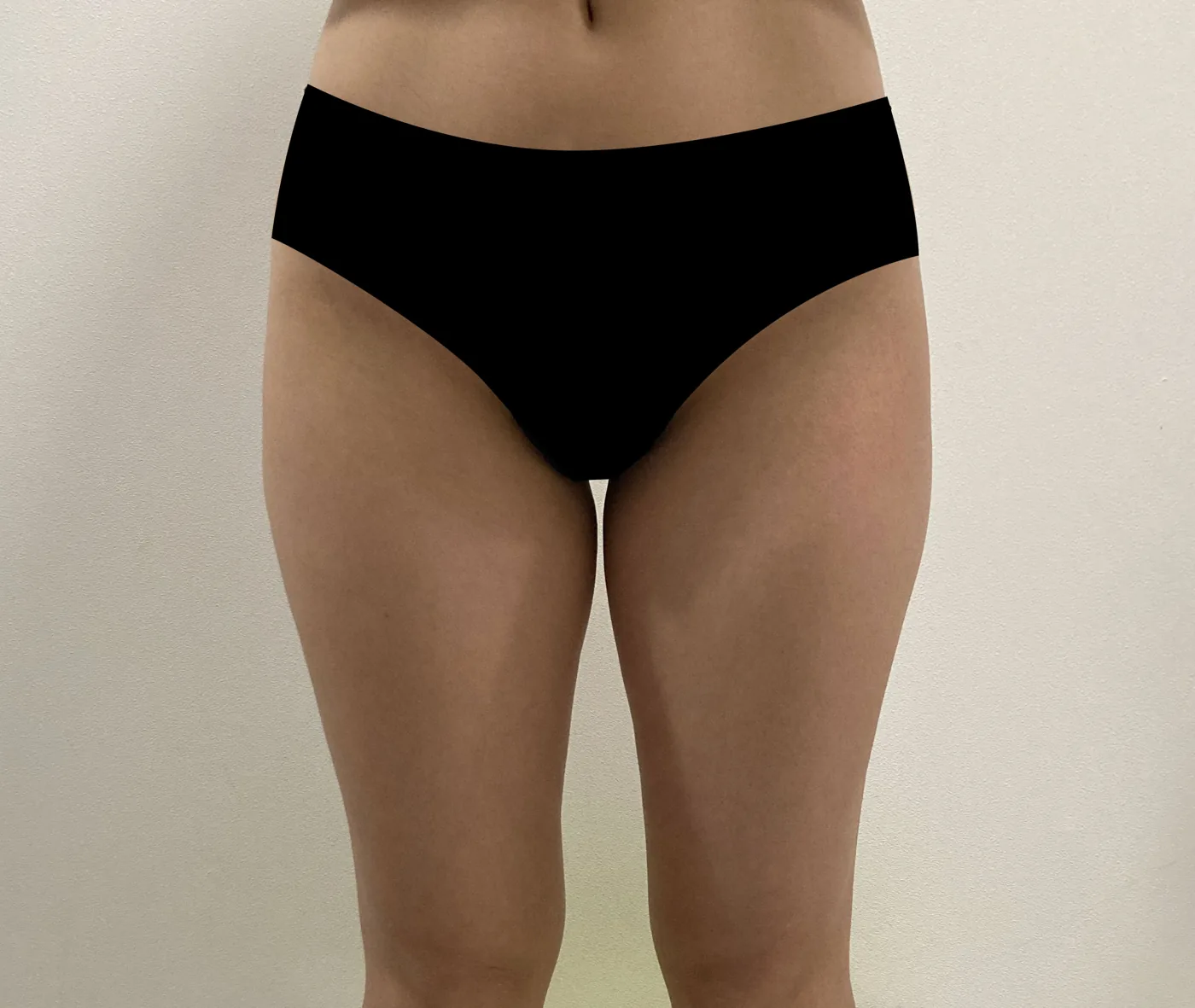 G-fat inner thigh extraction before, G Clinic Gangnam case 49