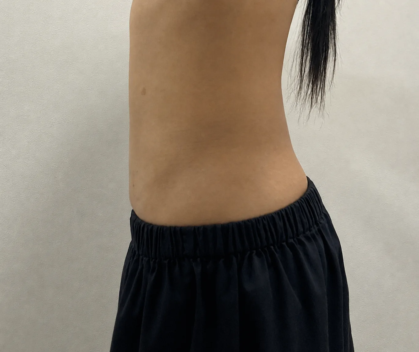 G-fat abdomen extraction after, G Clinic Gangnam case 50