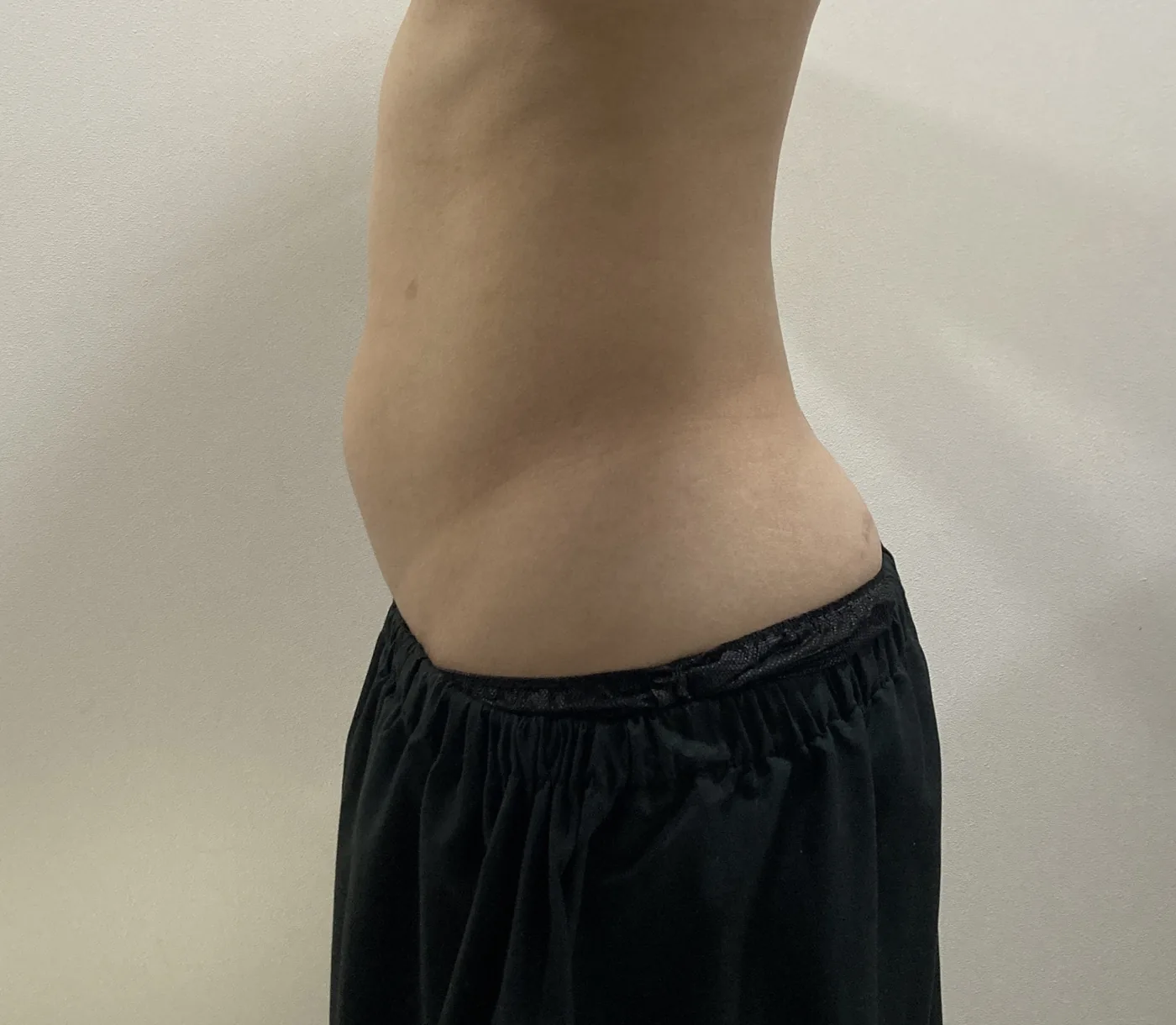 G-fat abdomen extraction before, G Clinic Gangnam case 50