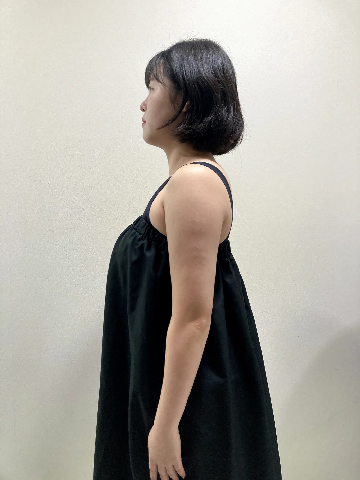 G-fat arm extraction after, G Clinic Gangnam case 51