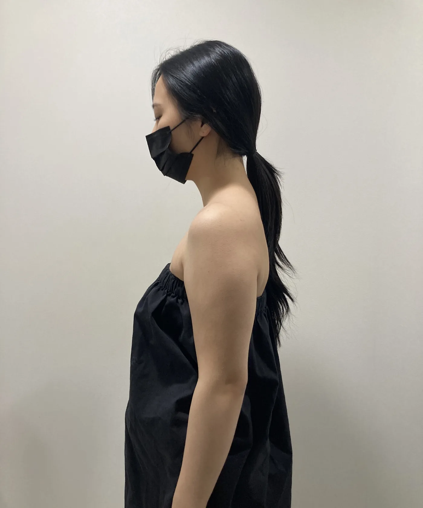 G-fat arm extraction before, G Clinic Gangnam case 52