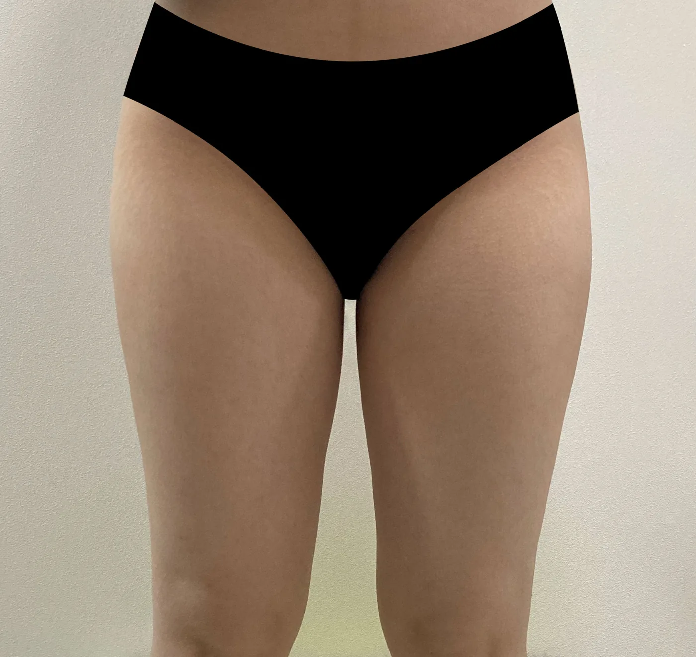 G-fat inner thigh extraction after, G Clinic Gangnam case 53