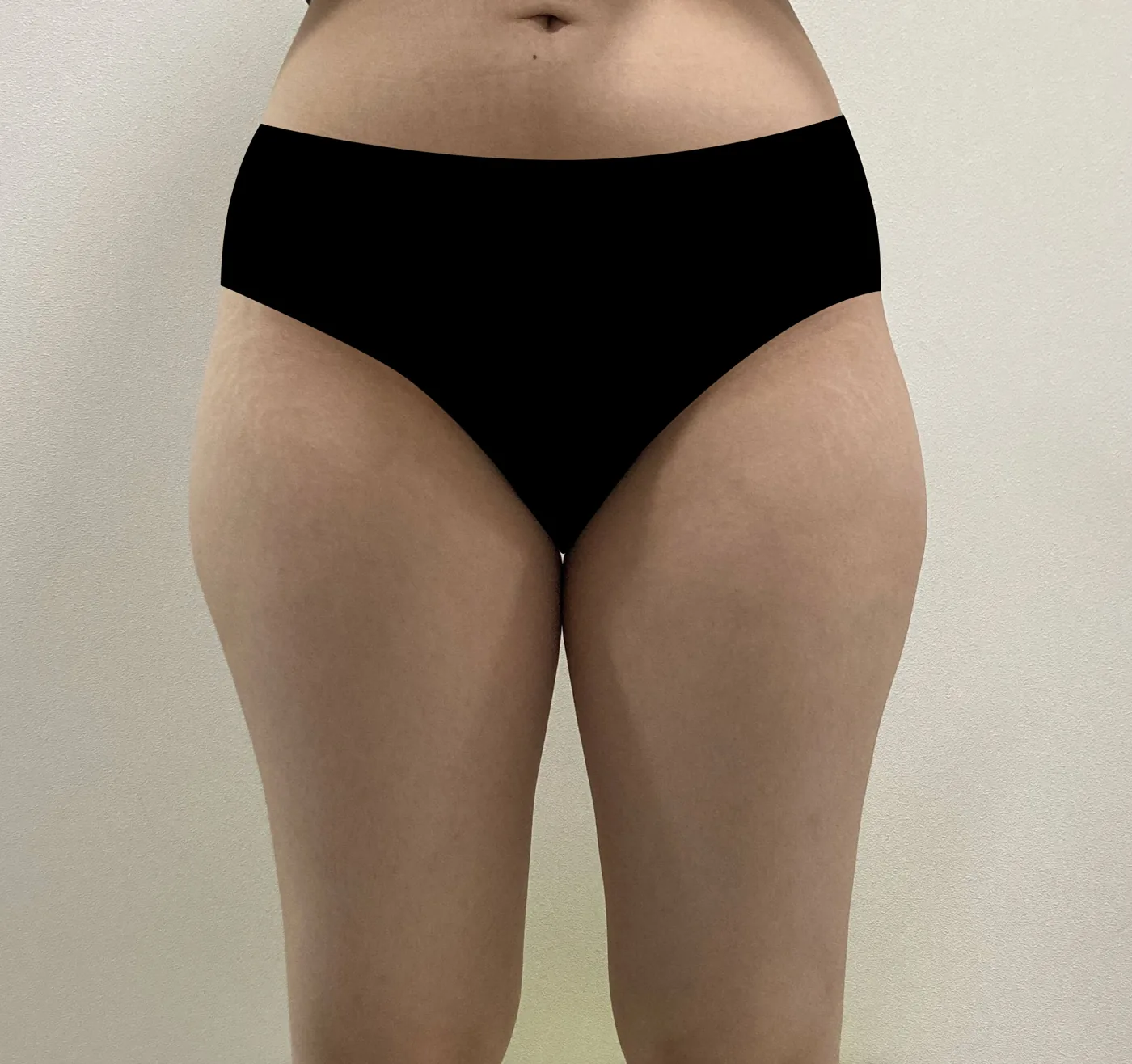 G-fat inner thigh extraction before, G Clinic Gangnam case 53