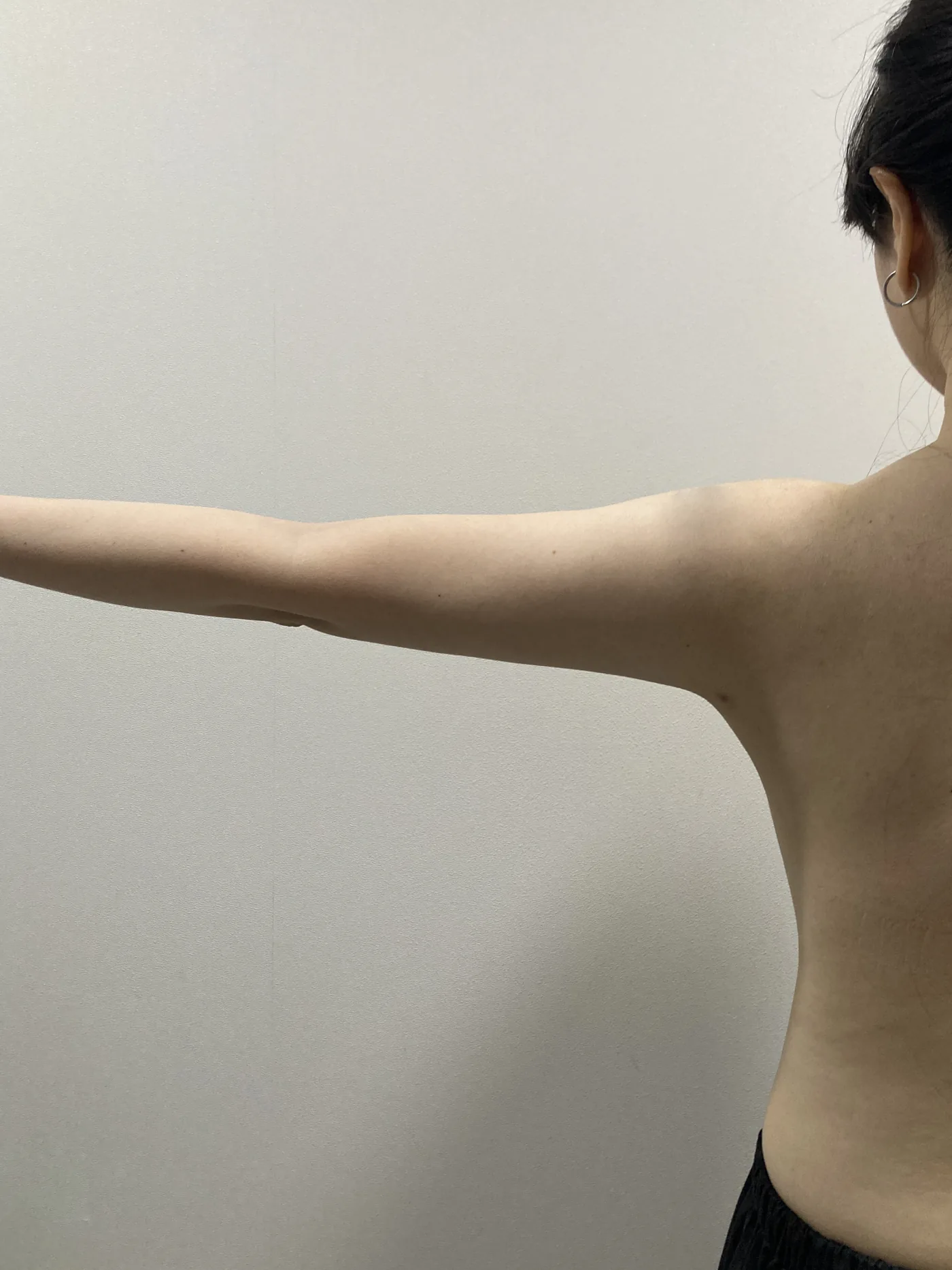 G-fat arm extraction after, G Clinic Gangnam case 54