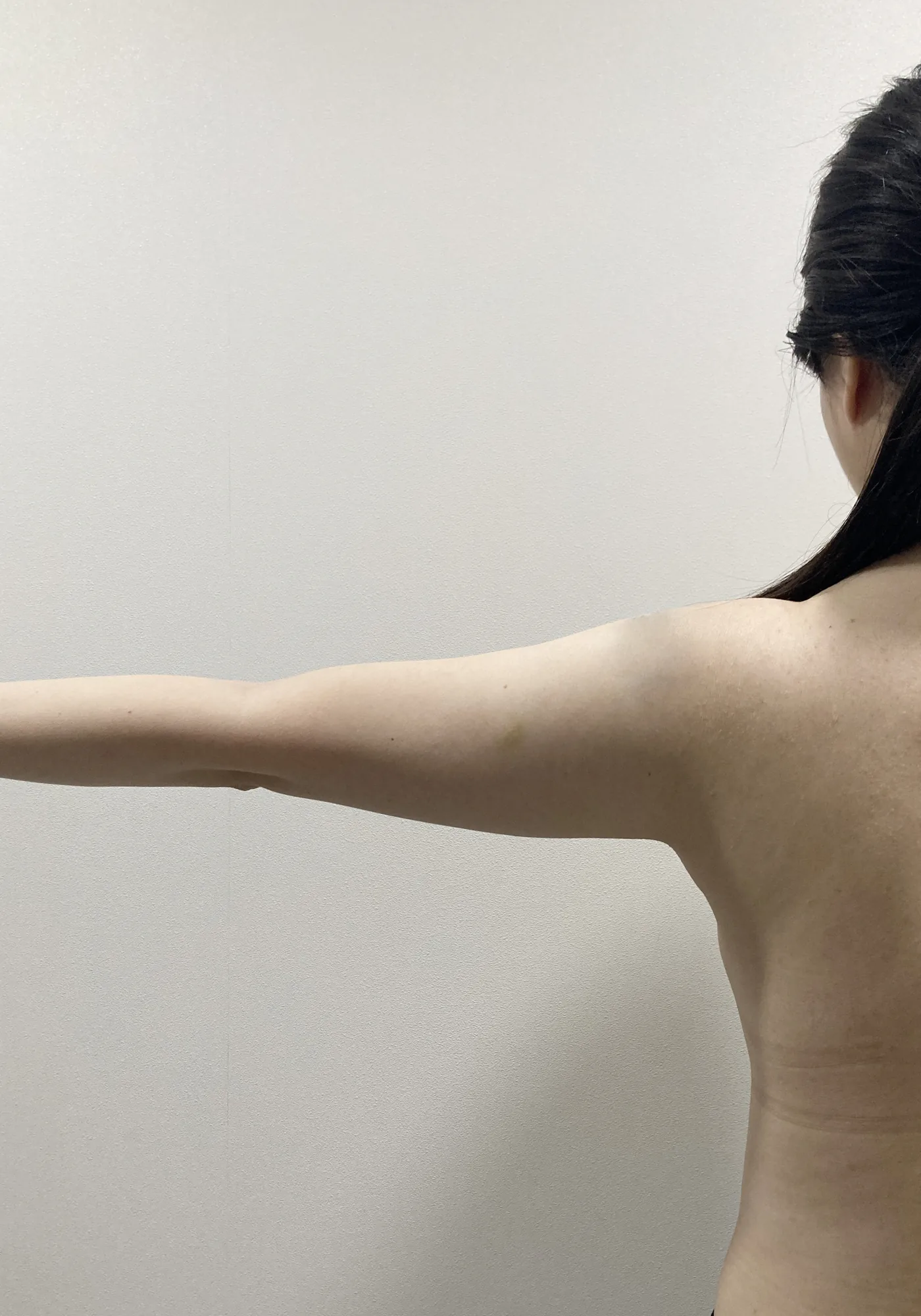 G-fat arm extraction before, G Clinic Gangnam case 54