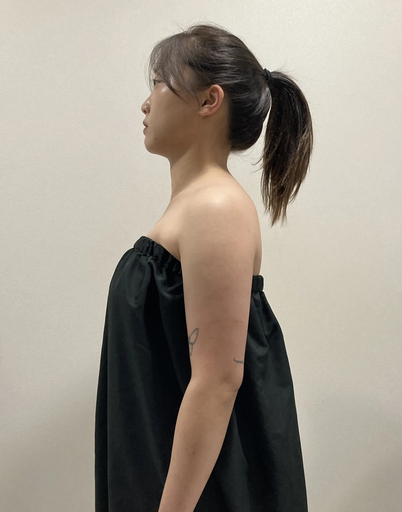 G-fat arm extraction after, G Clinic Gangnam case 56