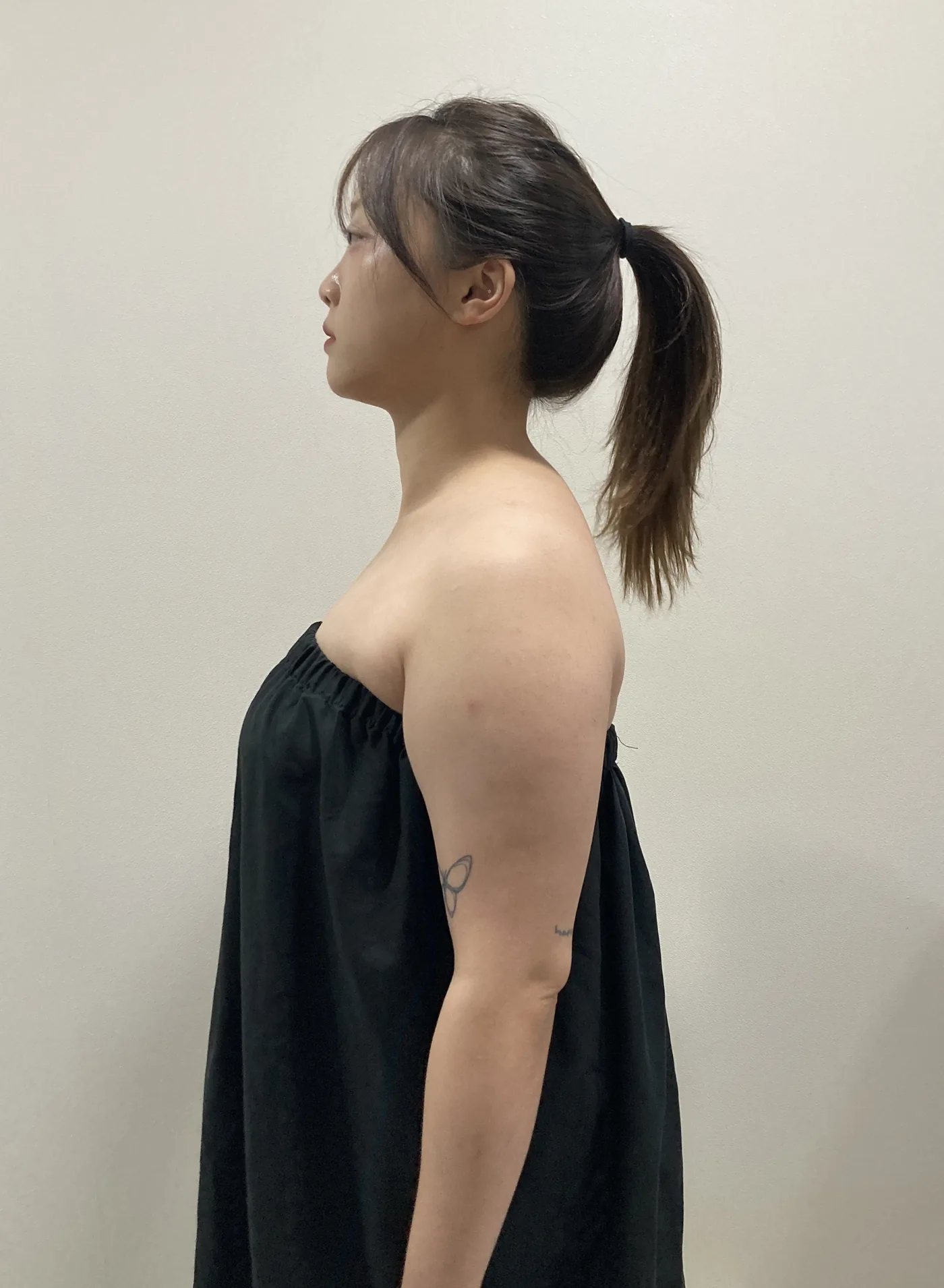 G-fat arm extraction before, G Clinic Gangnam case 56