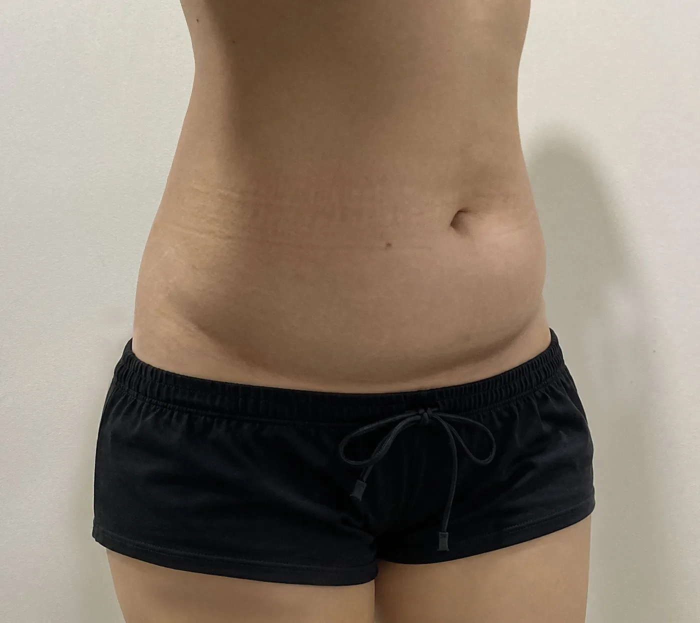 استخراج جي-فات لدهون البطن قبل الجلسة، G Clinic كانغنام الحالة 57
