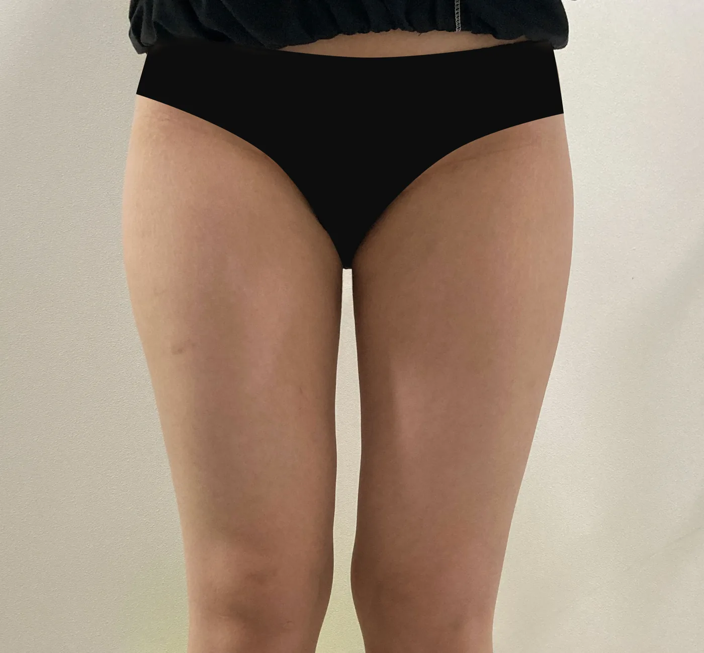 Thigh G-fat after, clinic-reported case