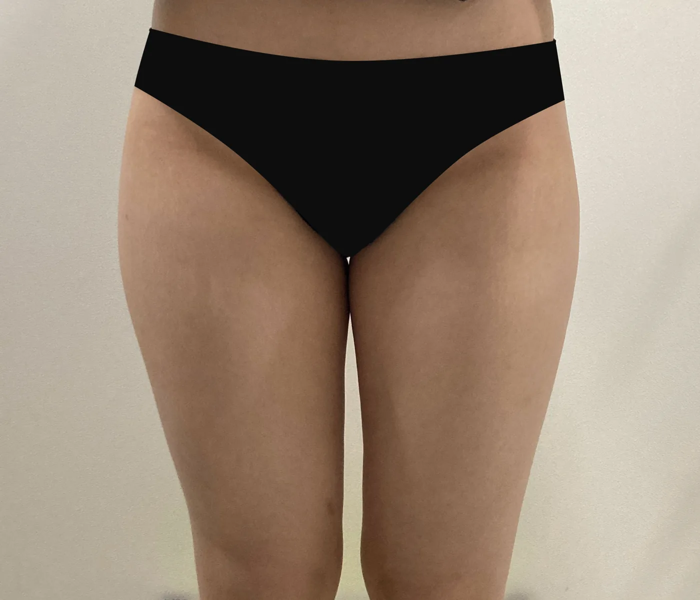 Thigh G-fat before, clinic-reported case