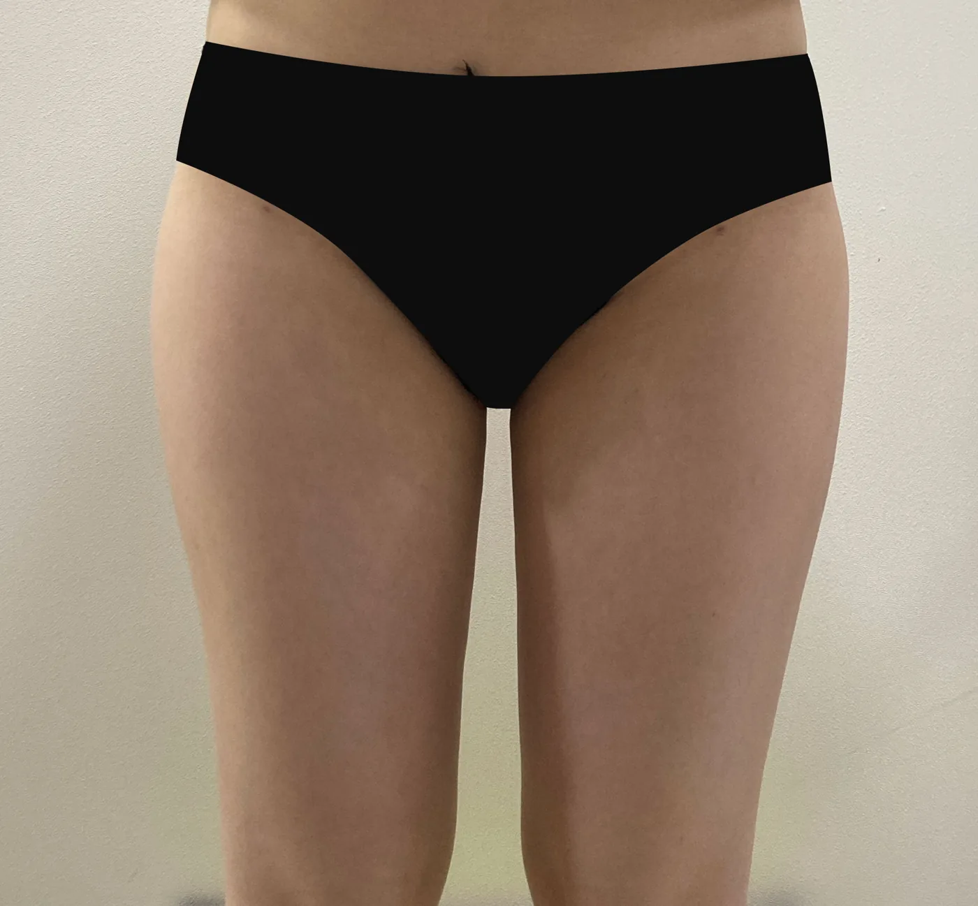 G-fat thigh extraction after, G Clinic Gangnam case 59
