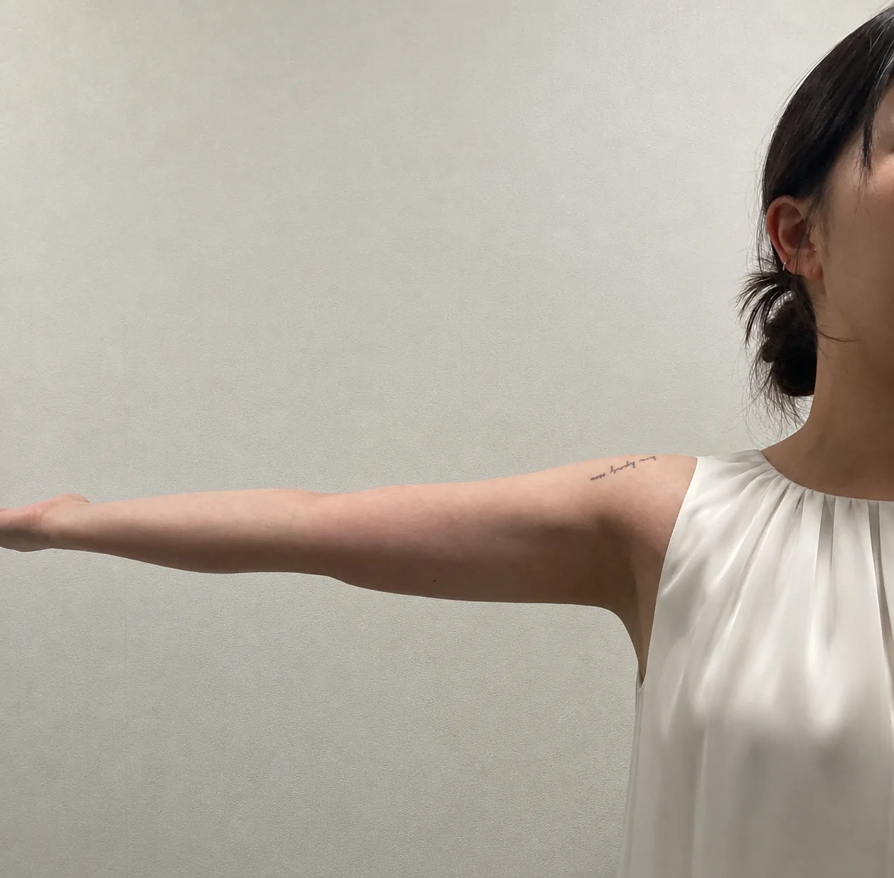 G-fat arm extraction after, G Clinic Gangnam case 64