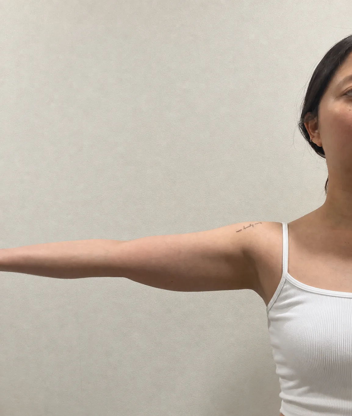 G-fat arm extraction before, G Clinic Gangnam case 64