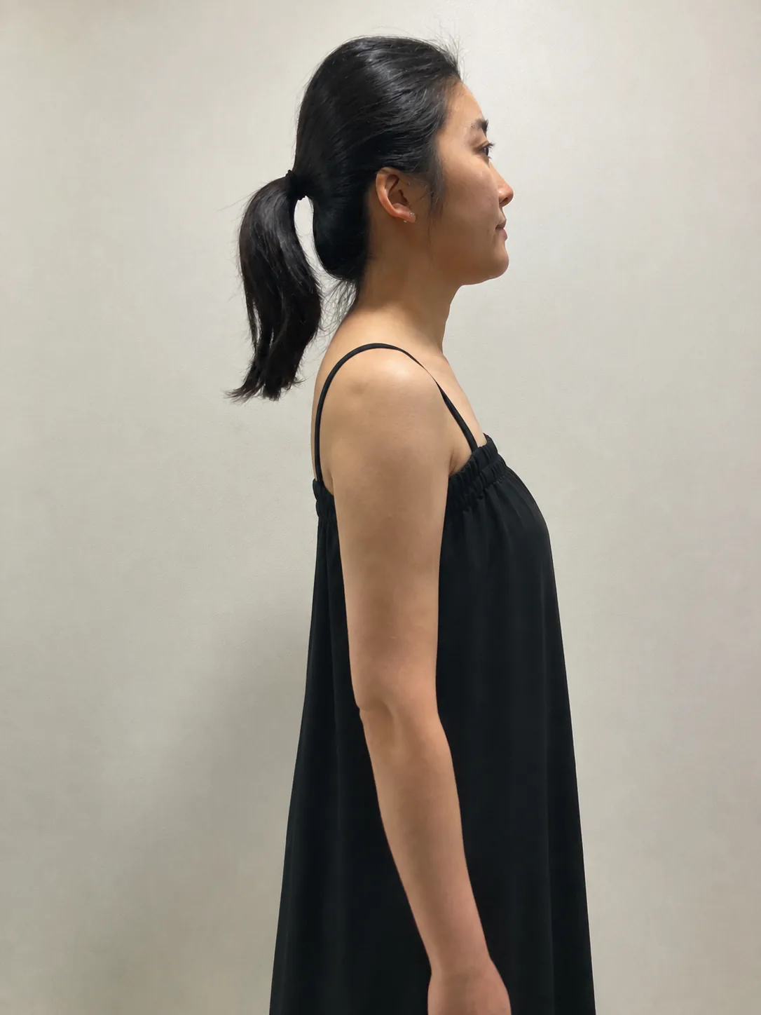 G-fat arm extraction after, G Clinic Gangnam case 65
