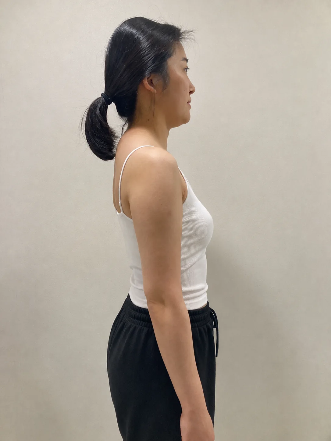 G-fat arm extraction before, G Clinic Gangnam case 65