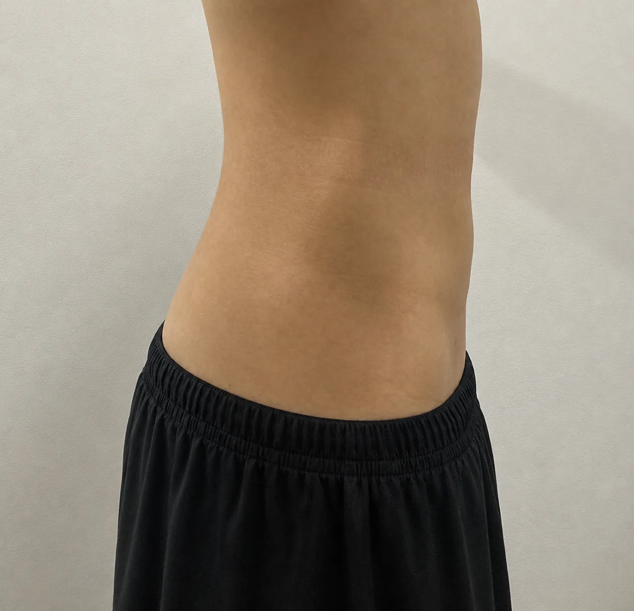 G-fat abdomen extraction after, G Clinic Gangnam case 66