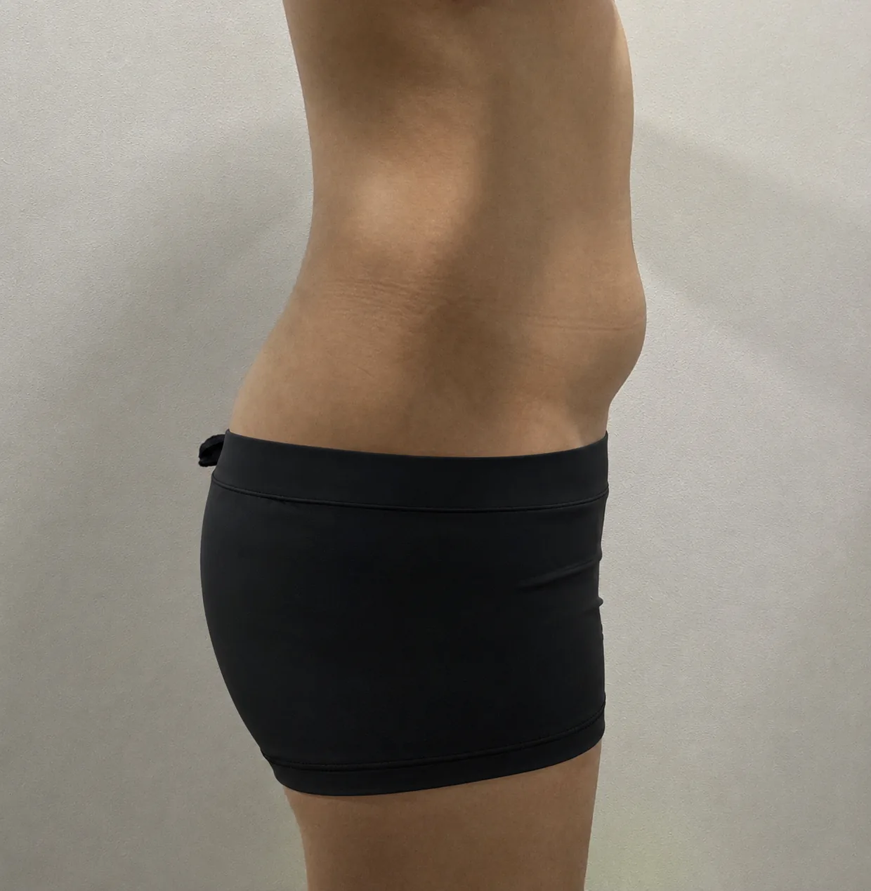 G-fat abdomen extraction before, G Clinic Gangnam case 66