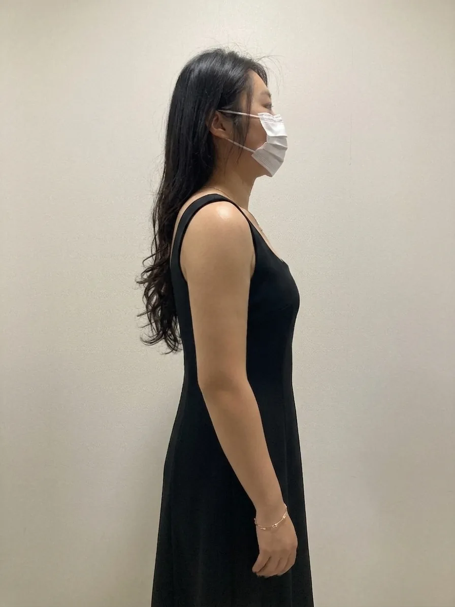 G-fat arm extraction after, G Clinic Gangnam case 67