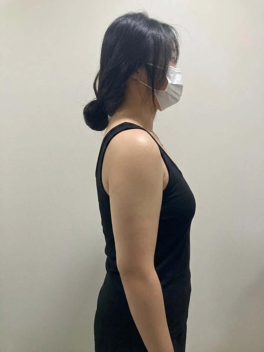 G-fat arm extraction before, G Clinic Gangnam case 67