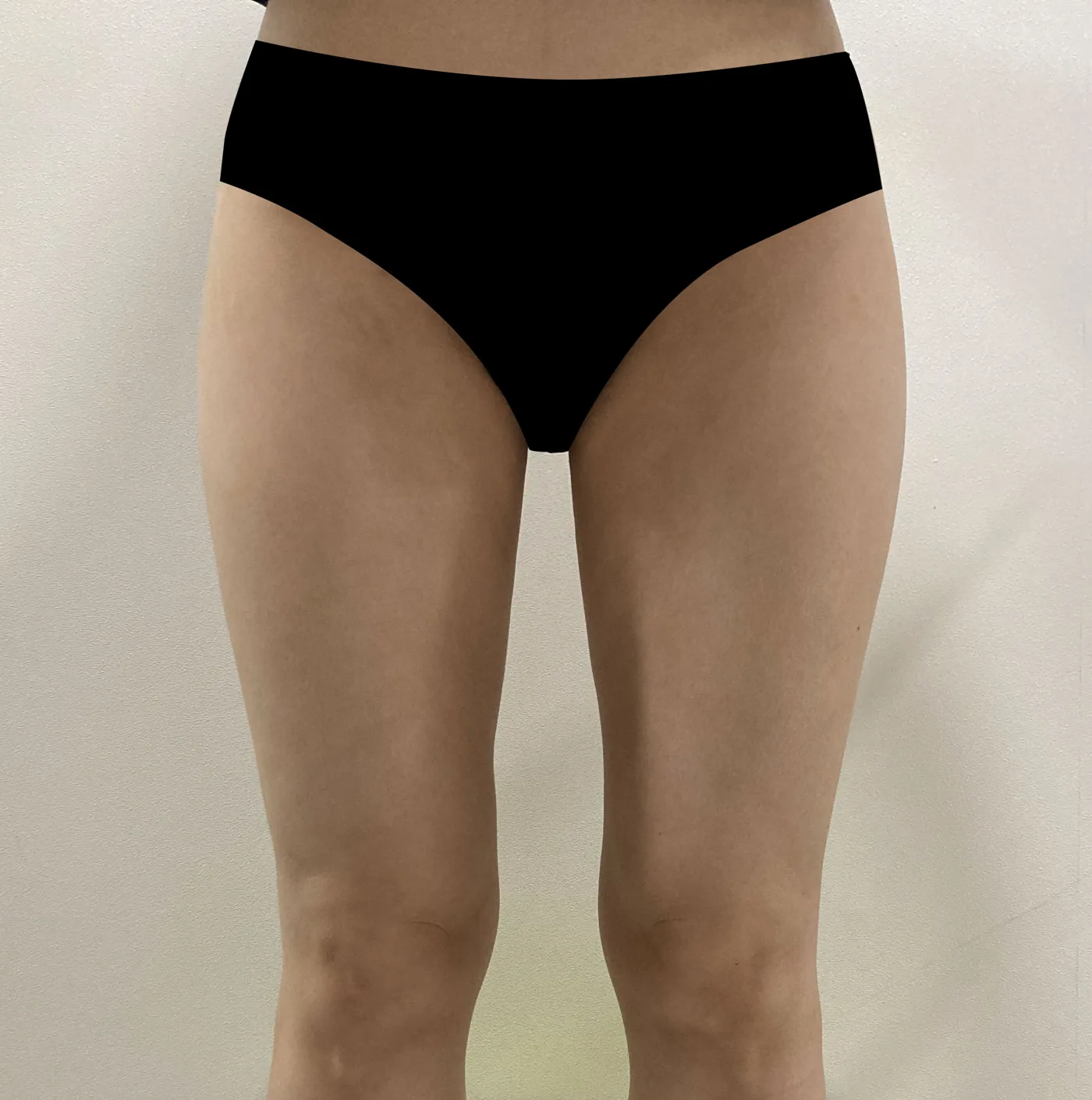 G-fat inner thigh extraction after, G Clinic Gangnam case 68